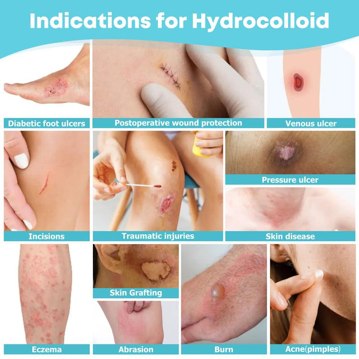 LIFARA Hydrocolloid Roll for Wound Care - Cut-To-Size, Extra Large Hydrocolloid Patch Bandages with Self-Adhesive, Ultra Absorbent, Flexible & Waterproof, First Aid Kit Essential (2In*16Ft, 11.8Mil/ 0.3Mm Thickness)) Healthcare Acne Pimple Patch Bandaids