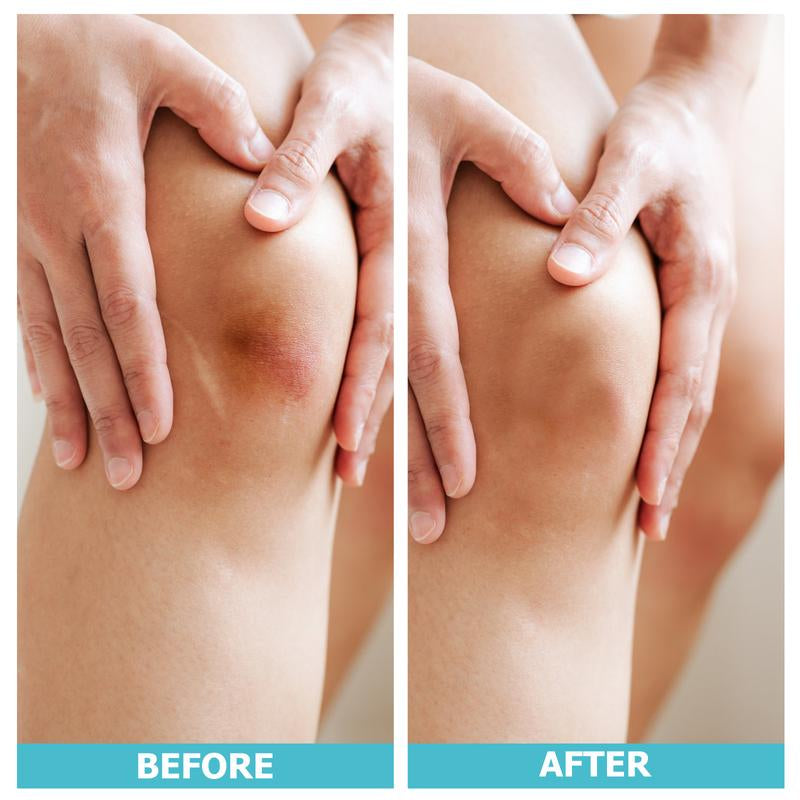 LIFARA Hydrocolloid Roll for Wound Care - Cut-To-Size, Extra Large Hydrocolloid Patch Bandages with Self-Adhesive, Ultra Absorbent, Flexible & Waterproof, First Aid Kit Essential (2In*16Ft, 11.8Mil/ 0.3Mm Thickness)) Healthcare Acne Pimple Patch Bandaids